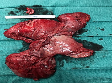 Excised specimen, soft-tissue mass consisting of an irregular piece of red-tan soft to firm tissue, measuring 31.5 × 20.0 × 0.8 cm along with overlying skin (not shown).