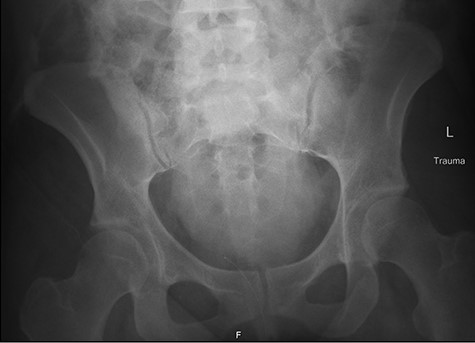 Pelvic X-ray showing intact pelvic ring.