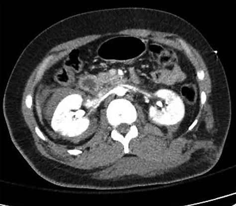 CT-CAP revealing Grade 4 bilateral ureteral injury.