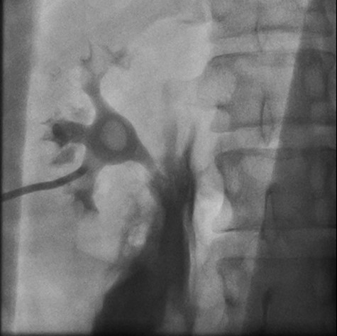 Right retrograde cystoscopy exhibiting extravasation of contrast.