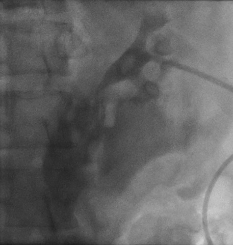 Left retrograde cystoscopy exhibiting extravasation of contrast.