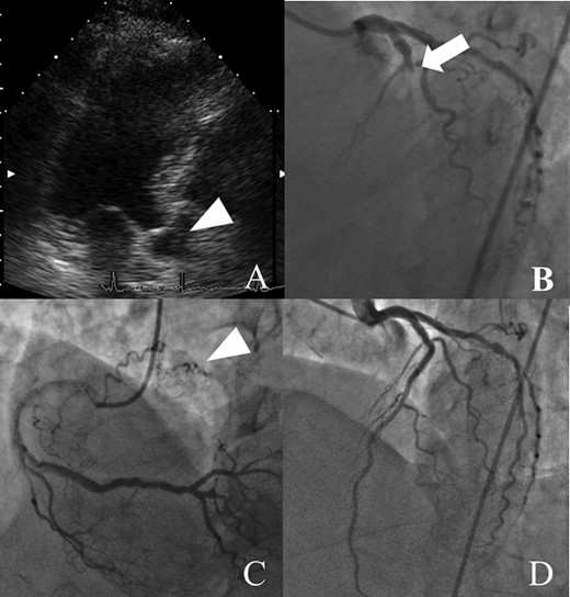 Preoperative examination findings (A–C): trans-esophageal echocardiography findings. (D) Enhanced computed tomography findings. Each image shows an IAS tumor with a solid mass and calcification suggesting a thrombotic IAS tumor (arrowheads). LA, left atrium; RA, right atrium; LV, left ventricle.