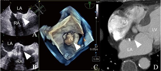 Intra- and postoperative histological findings. (A) Trans-right atrial view. The tumor is attached to the IAS wall. (B) The hard capsule with calcification. (C) Pathological findings. Concentric arrangement of cells around vascular cells, which is typical of myxomas.