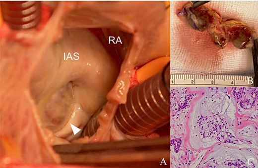 Preoperative findings before percutaneous coronary artery intervention. (A) CAG shows the totally occluded left coronary artery suggesting embolization by thrombus or tumor (arrow). (B) Follow-up CAG shows no signs of arteriosclerosis, such as diffuse constriction. (C, D) Six years before presentation, right coronary artery angiography shows a tumor with feeding vessels, and echocardiography shows an IAS tumor (arrowheads), suggesting that the tumor was present at that time.