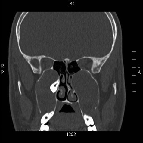 Coronal CT images showing bilateral cystic lesions in the maxillary antra with expansion and remodeling of the roof, lateral and medial walls, the right cystic lesion displaces ectopic tooth superiorly and medially in the region of the expanded remodeled ostiomeatal complex