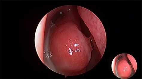 Intraoperative endoscopic view of frank pus draining the right maxillary sinus