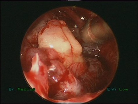 Intraoperative endoscopic view of ectopic tooth and the cyst, the patient’s symptoms were resolved completely postoperatively and remained symptoms free for 4 years follow-up