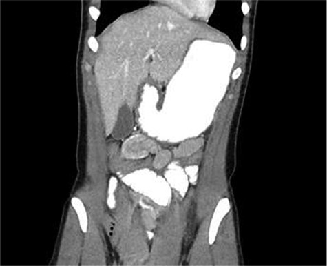 A 24-year-old female with CT scan with target sign in mid-right abdomen suggesting JJ intussusception
