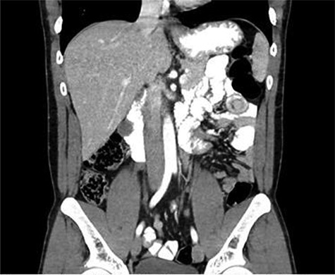 A 30-year-old male with CT scan with target sign in left upper quadrant suggesting JJ intussusception