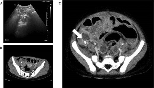 (A) and (B)—Case 1: abdominal ultrasound scan and computed tomography (CT) scan of abdomen, (C)—Case 2: CT scan of abdomen; white arrow shows faecolith with inflamed appendix and surrounding collections.