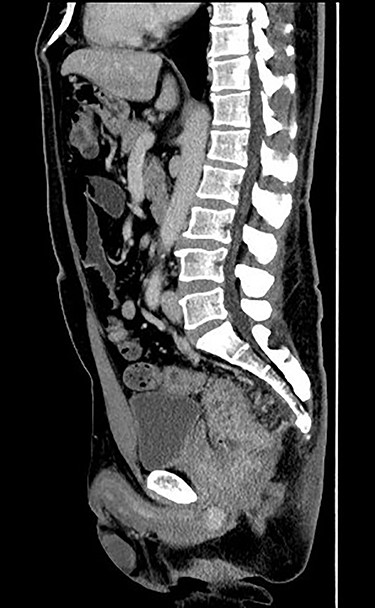 Enhanced computed tomography (CT) scan (sagittal image). Enhanced CT scan showed that the rectal tumor directly invades the prostate.
