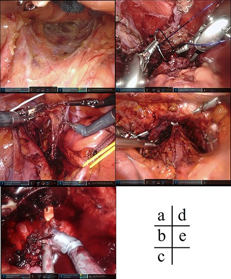 Intraoperative findings. (a) The rectum was detached passively, including the posterior wall of the rectum and the side wall. (b) Dissection of the lateral lymph nodes of the pelvis on both sides was performed. (c) The urethra was dissected and the urinary catheter was inserted during the prostatectomy. (d) A urethral anastomosis was performed after excision of the rectum including the prostate from the anus. (e) After specimen removal and reconstruction of the urinary tract.