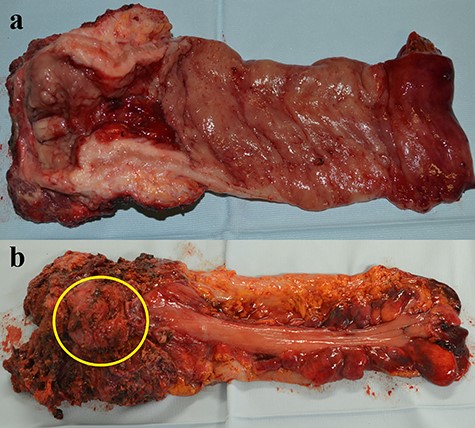 (a) On the mucous membrane side, there was a rectal tumor extending almost all around with a size of 10 cm × 11.5 cm. (b) On the serosa membrane side, a prostate gland that had been resected due to direct infiltration was found in a part of the specimen (yellow circle).
