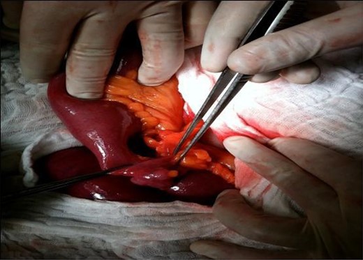 35 centimeters from the ileocecal valve, an 8-cm-long Meckel’s diverticulum had severe inflammation with the tip of it creating a symphysis band with the mesenterium.