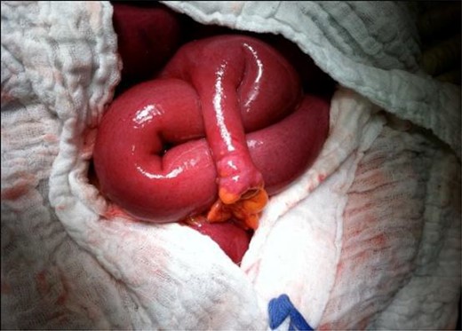 Ileal loops were dilated at the superior part of the mechanical obstruction.