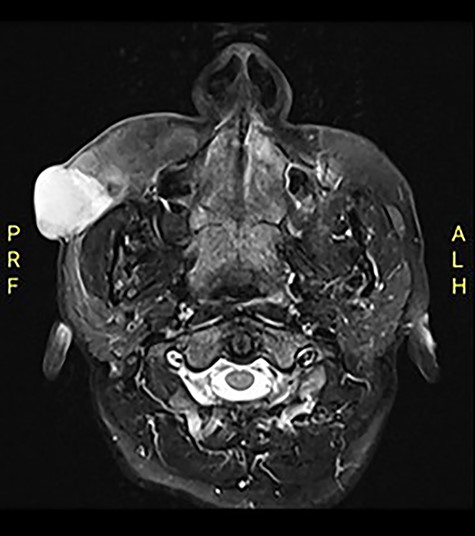 MRI face T2 axial cut shows right cheek enhanced mass.