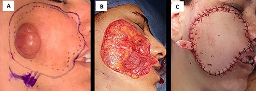 (A) intraoperative image shows right cheek mass, (B) postoperative defect in right cheek lesion and (C) anterolateral thigh flap completely covers the postsurgical defect.