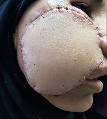 View of postoperative day 7 shows flap almost completely healed.