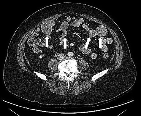CT scan: multiple solid density processes with colliquation areas within them (white arrows) in the abdominal cavity.
