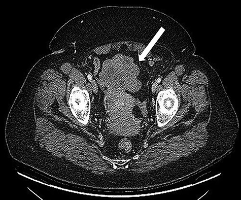 CT scan: Bulky (8.0 × 6.5 cm) mass located in the pelvis in close contact with the uterine fundus.