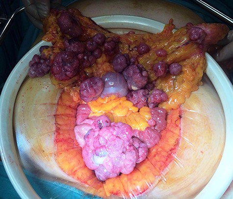 Sarcomatous omentum at laparotomy.