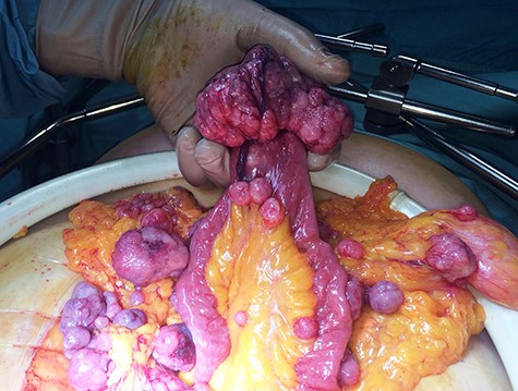 Bulky mass with adjacent small bowel and mesenteric implants.