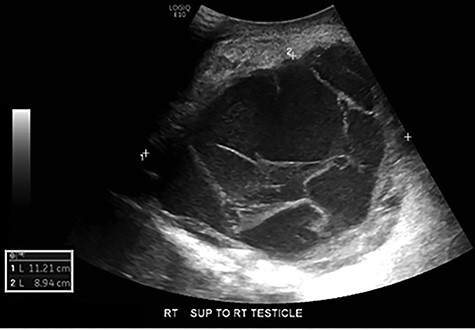 Scrotal ultrasound: complex septated cystic lesion on the right side of the scrotum measuring 11.2 x 8.9 x 11.6 cm. Nonspecific scrotal wall thickening was noted.