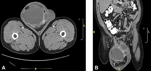 Axial (a) and sagittal (b) CT of abdomen and pelvis with oral and intravenous contrast: showed a large complex cystic and solid mass measuring 12.0 x 15.5 x 19.0 cm in the right scrotum.