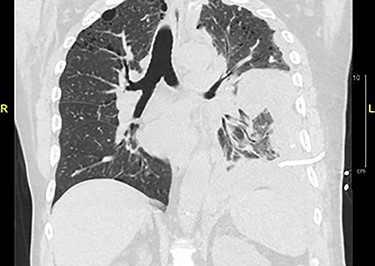 CT chest without contrast: extensive lobulated left-sided pleural thickening with effusion, consistent with metastatic disease.