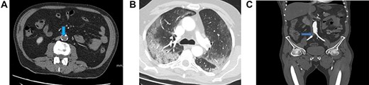 (A) A CT scan of the chest showed patchy and ground-glass shadowing predominantly in the bilateral lower lung lobes. (B) CT-thorax showing pulmonary changes. (C) CT-angiogram demonstrating aorta and left CIA patency with residual thrombus in right CIA post-operatively (blue arrow)