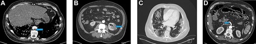 (A) Filling defect in aorta (blue arrow). (B) Left renal infarct (blue arrow). (C) CT-thorax showing pulmonary changes. (D) Thrombus in the distal SMA (blue arrow)
