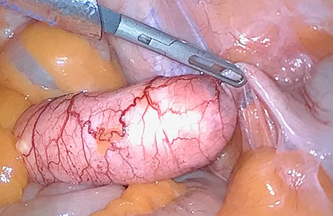 Case 1: intraoperative finding.