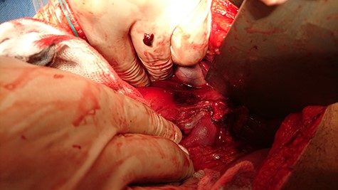 End-to-end anastomosis of the common hepatic artery.