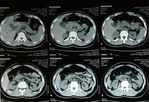 Follow-up computed tomography scan of the abdomen showing no abnormalities.