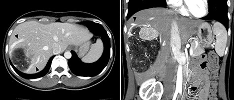 Abdominal computed tomography (CT) 5 years before referral to our hospital; enhanced CT revealed mixed density tumor measuring 12 × 10 cm in the right lobe of the liver; a peritumoral early drainage vein around the tumor (arrow heads) was visualized.