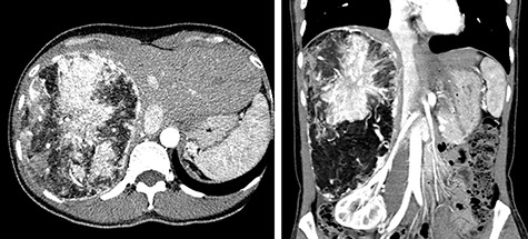 Abdominal CT on admission; the tumor had enlarged, occupying the entire right lobe of the liver, and measuring 200 × 140 × 120 mm.