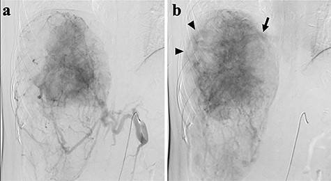 Abdominal angiography; (a) hepatic angiography shows a hypervascular tumor with a fine network of vessels in the arterial phase; (b) dilated and tortuous vessels (arrow heads) were noted inside the tumor, then a drainage vein to the right hepatic vein (arrow) was visualized in the early phase.