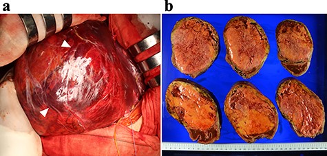 Intraoperative findings (a) and the resected specimen (b); (a) a dilated abdominal vein was observed on the surface of the liver (arrows); (b) the cut surface of the resected specimen revealed a heterogenous appearance with areas of hemorrhage (red) and fatty components (yellow) with a capsule.