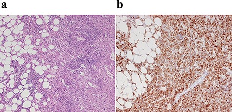 Histopathological findings; (a) the tumor was composed of mature lipocytes with angiomatous and small lymphocytic components, but showed no mitotic figures; (b) immnohistochemically, the tumor was positive for HMB45.