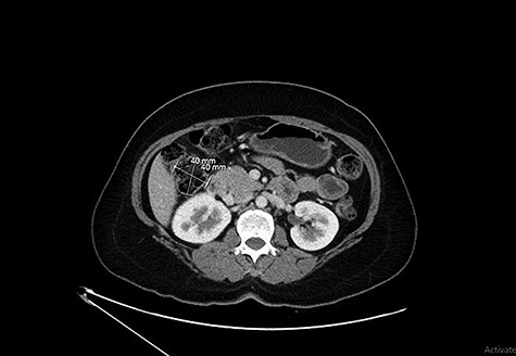 CT showing a lipoma arising from the wall of the ascending colon without causing obstruction.
