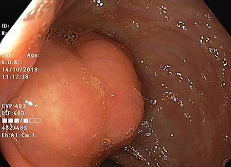 Colonoscopic image of ascending colon lipoma showing normal mucosa.