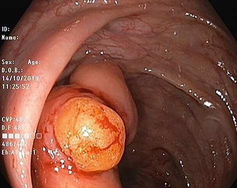 Colonic lipoma after biopsy showing typical yellowish adispose tissue.