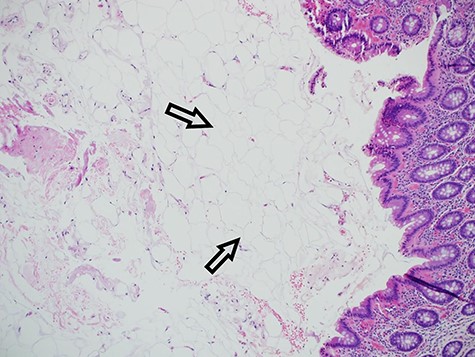 Histopathology showing mature adipose tissue.