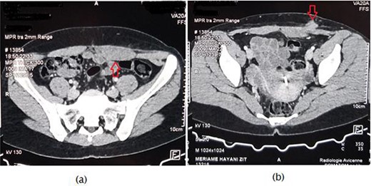 Axial computed tomography scan revealing (a) nodular hypertrophy of the lower left rectus abdominus, (b) mass of 2.1 × 1.7 cm in the left iliac fossa in touch with the rectus muscle.