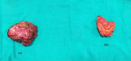 (a) surgical specimen of rectus abdominis endometrioma, (b) surgical specimen of subcutaneous left iliac fossa endometrioma.
