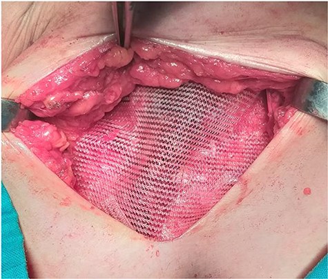 The use of a polypropylene mesh after R0 resection with significant defect in the aponeurosis.