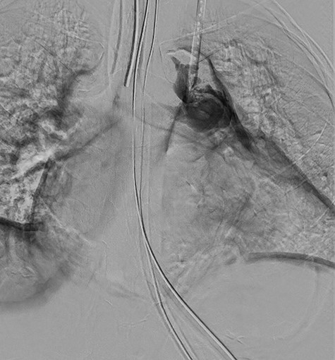 Digital subtraction angiography from operating room fluoroscopy.