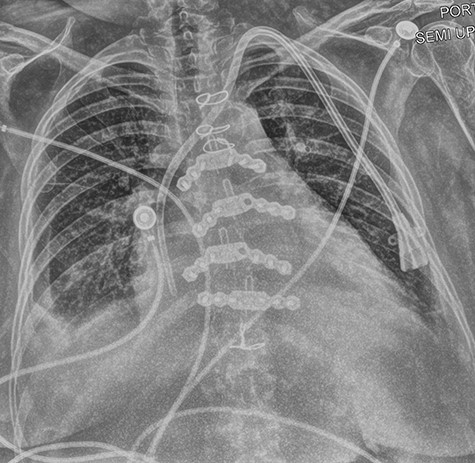 Predischarge post-op day 7 chest X-ray.
