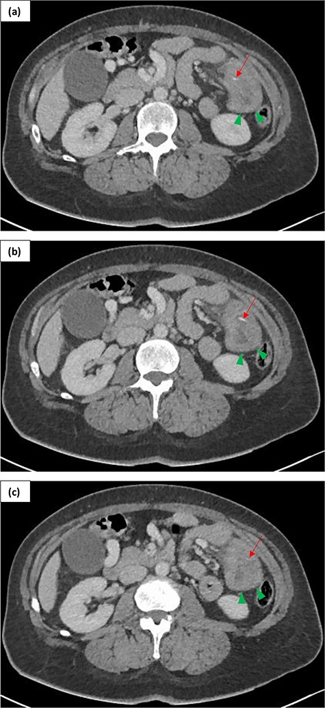 Contrast enhanced (portal phase) CT of a 54-year-old female presenting with LIF peritonism in context of previous RYGBP over 10 years ago. Serial images in axial plane (a, b, c) demonstrate thickened small bowel loops in the left flank (green arrowheads) and a fishbone as a linear hyper density (red arrow).