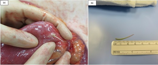 Intraoperative photographs taken during exploratory laparotomy of a 54-year-old female presenting with LIF peritonism. (a) A fishbone was identified protruding from the lumen of the blind end loop of the Roux-en-Y anastomosis (patient had history of previous RYGBP for obesity). (b) Fishbone after its extraction.